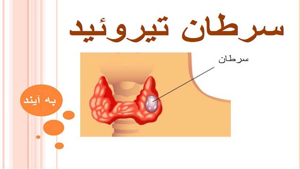 سرطان تیروئید روی غده تیروئید 