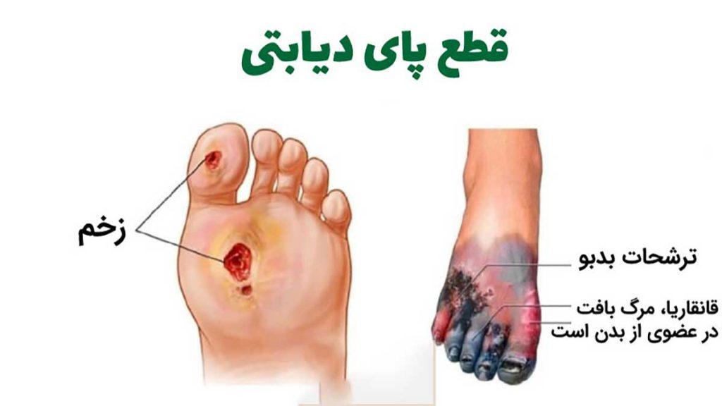 دکتر زخم پای دیابتی