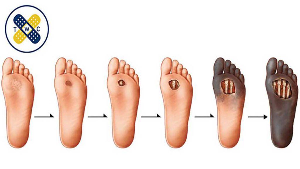 زخم پای دیابتی