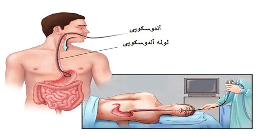 آندوسکوپی معده