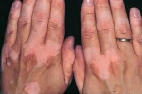 بهترین دکتر پوست برای درمان پیسی