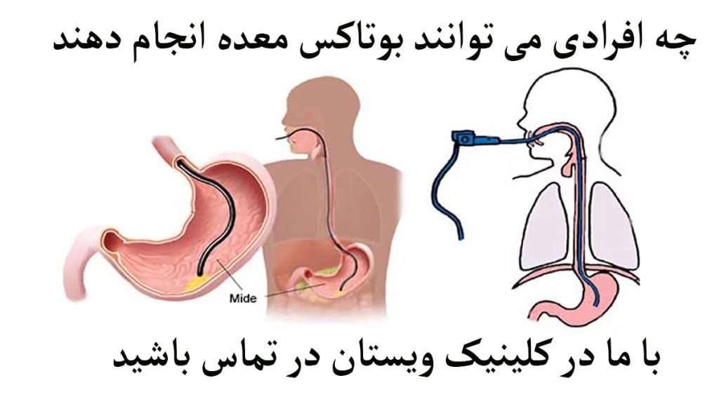 طریقه انجام بوتاکس معده نمایش داده می شود
