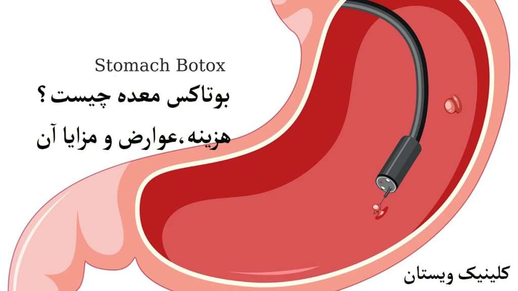 بوتاکس معده و طریقه انجام آن نمایش داده می شود