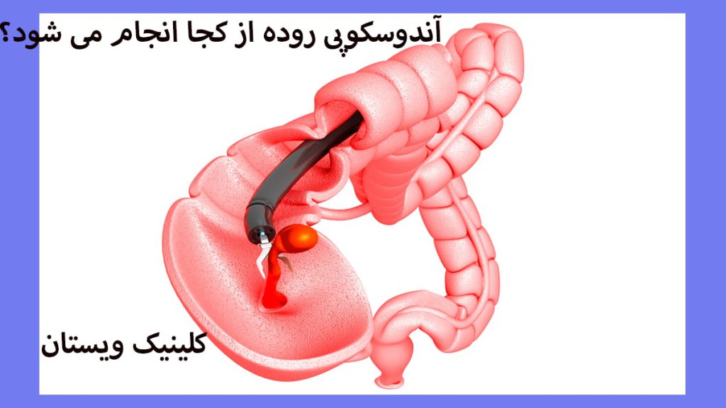 دستگاه آندوسکوپی در داخل روده 