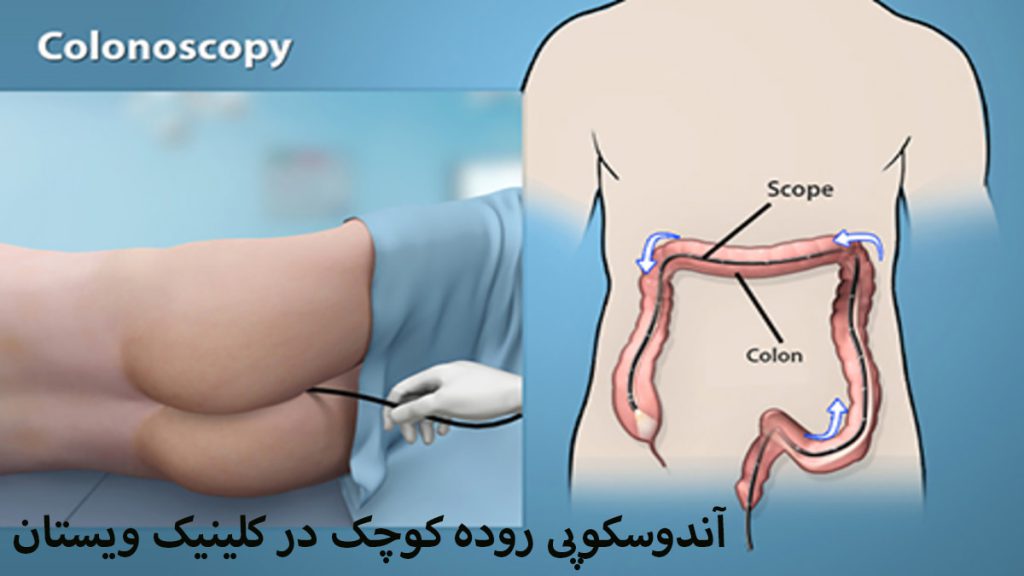 در سمت چپ شخصی در حال انجام کولونوسکوپی و در سمت راست روده انسان و تصویر داخل شکم نشان داده می شود