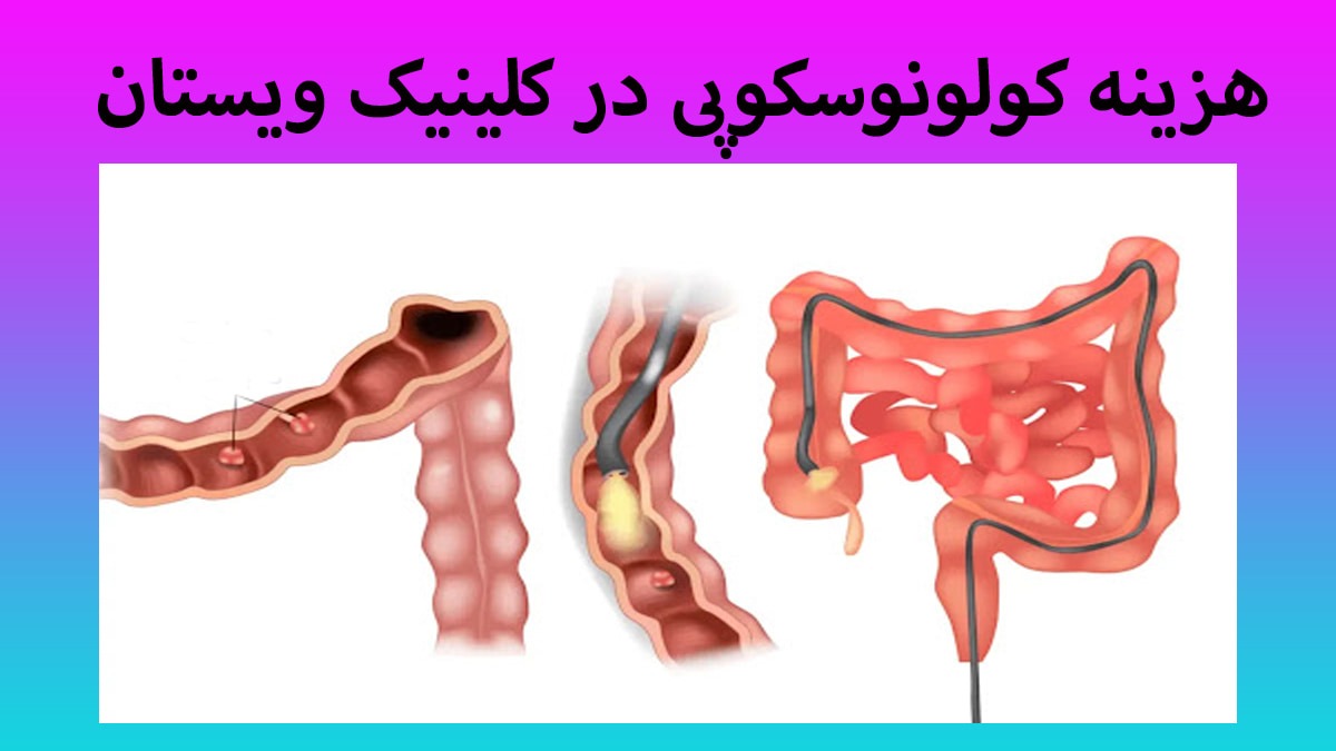 تصویری از یک روده که در آن کولونوسکوپی انجام می شود + هزینه کولونوسکوپی با بیهوشی تصویری از یک روده که در آن کولونوسکوپی انجام می شود + هزینه کولونوسکوپی با بیهوشی