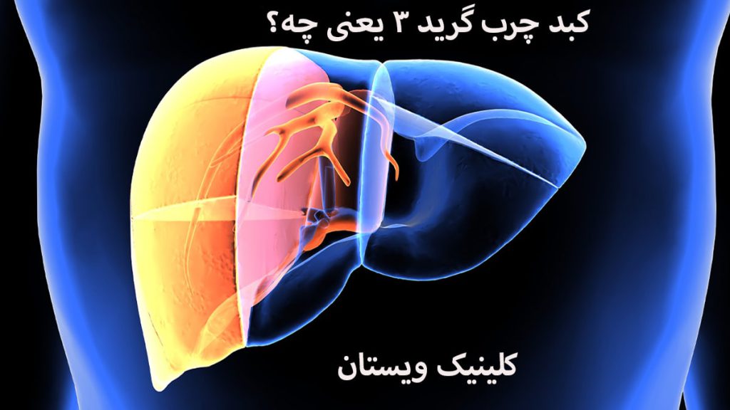 یک کبد که دچار چربی شده است و یک نوشته با عنوان کبد چرب گرید 3