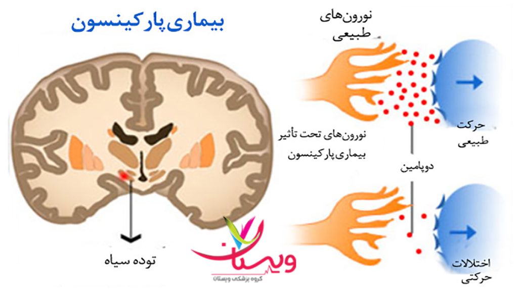 5 مرحله بیماری پارکینسون مراحل ایجاد بیماری پارکینسون