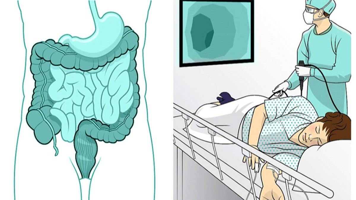 موارد تجویز کولونوسکوپی