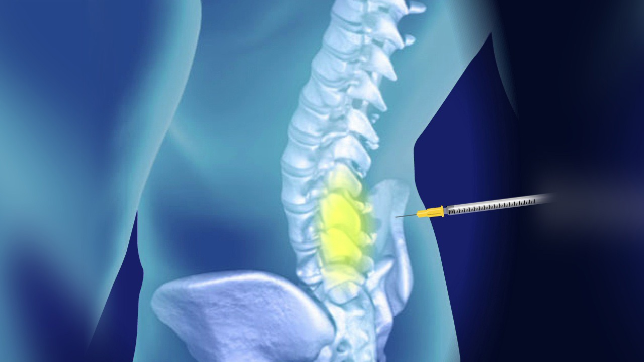 تزریق پی آر پی در کلینیک ویستان