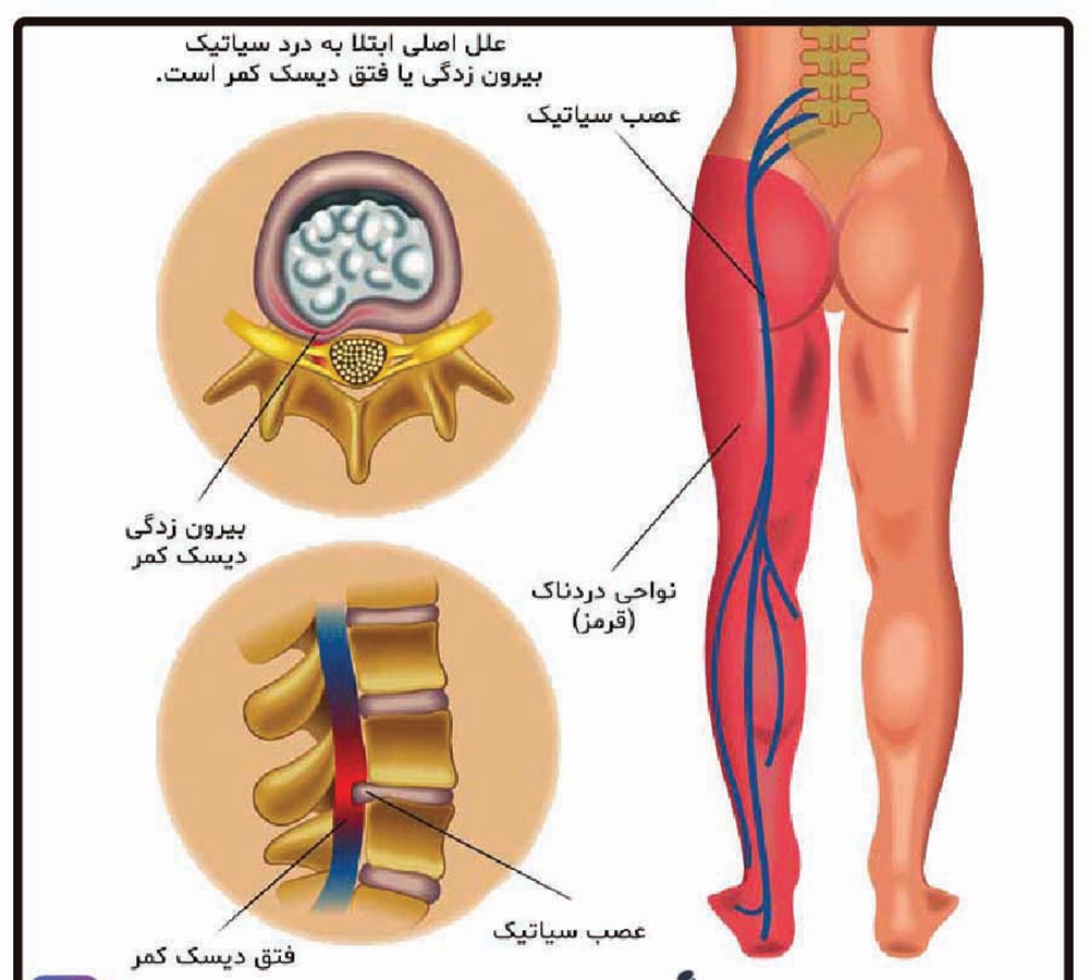بهترین کلینیک برای درمان درد سیاتیک