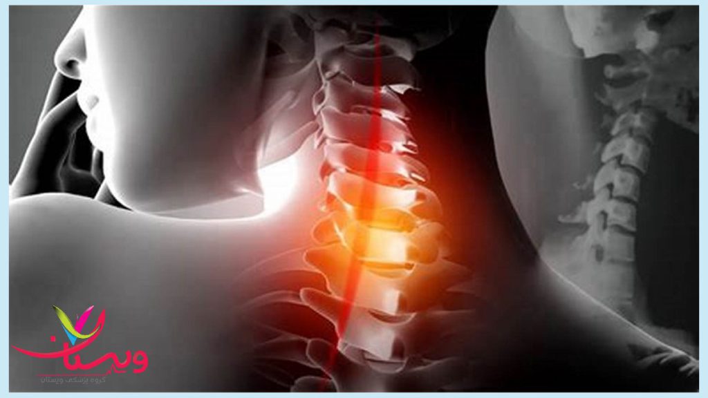 تصویر دیجیتالی از درد مهره هایرگردن-پزشک آرتروز در تهران