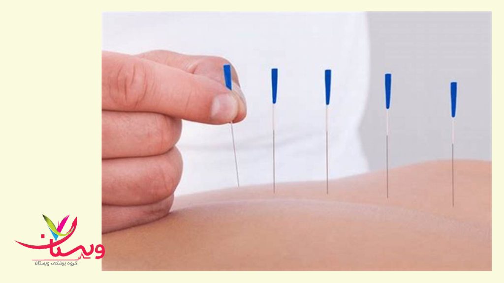 سوزن های طب مکمل که وارد بدن بیمار می شود-خانم دکتر متخصص طب سوزنی
