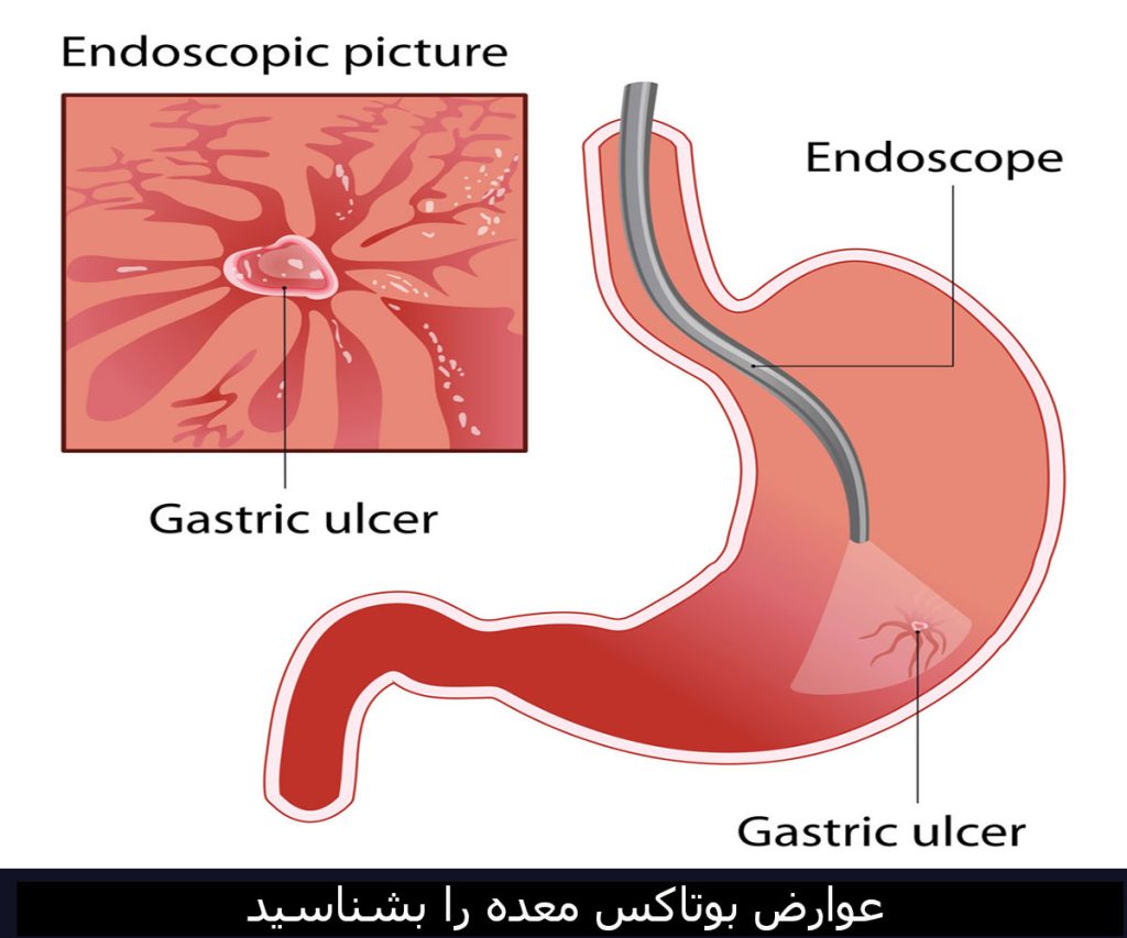 عوارض بوتاکس معده را بشناسید + بهترین دکتر متخصص بوتاکس معده