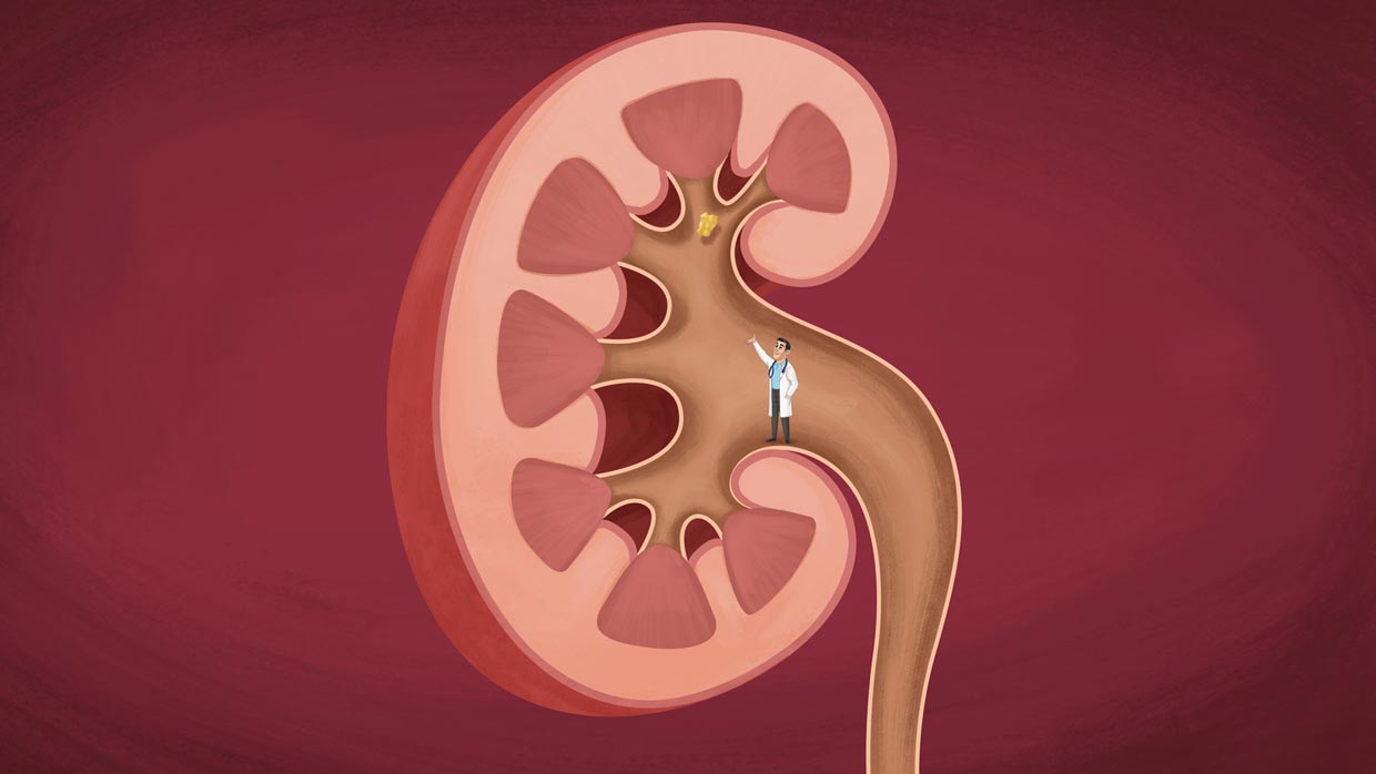 مشکلات کلیوی و درمان با روشهای نوین