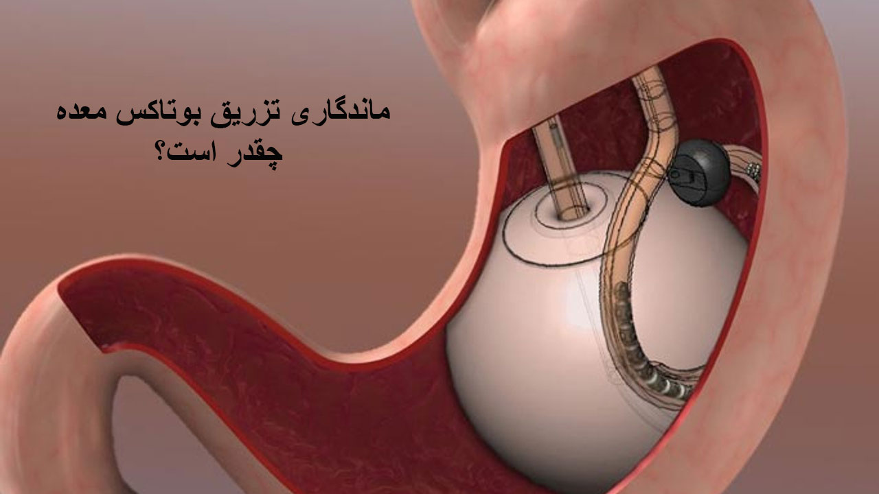 ماندگاری تزریق بوتاکس معده چقدر است؟