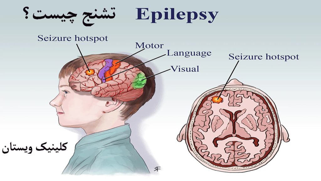 تشنج یعنی چه؟ تصویری انیمیشنی از یک شخص و مغز او که دچار تشنج شده است؟