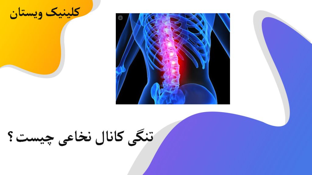 تصویری دیجیتالی از ستون فقرات انسان که به تنگی کانال نخاعی مبتلا است