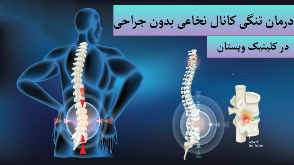 تصویری دیجیتالی از یک شخص و ستون فقرات او که به تنگی کانال نخاعی مبتلا شده است