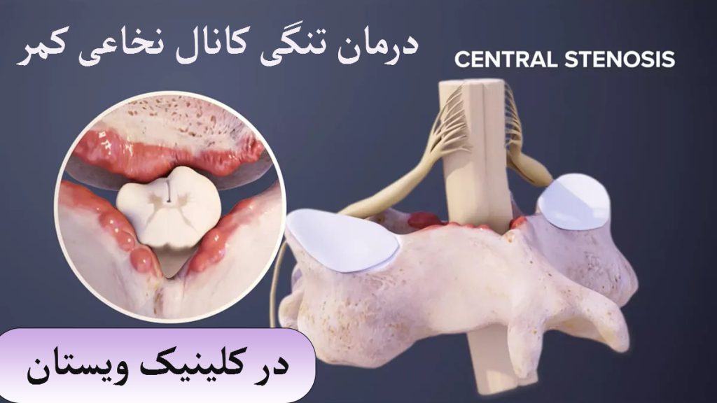 یک مهره کمر که به تنگی کانال نخاعی مبتلا است