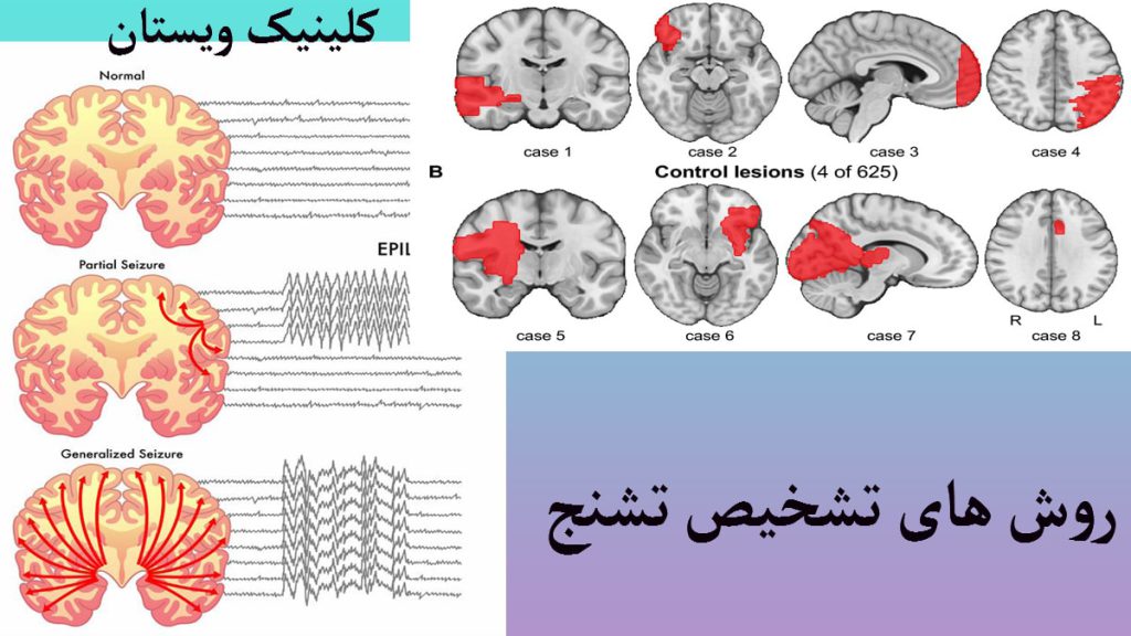 تشخیص تشنج نوار مغز و نقشه مغزی برای تشخیص تشنج