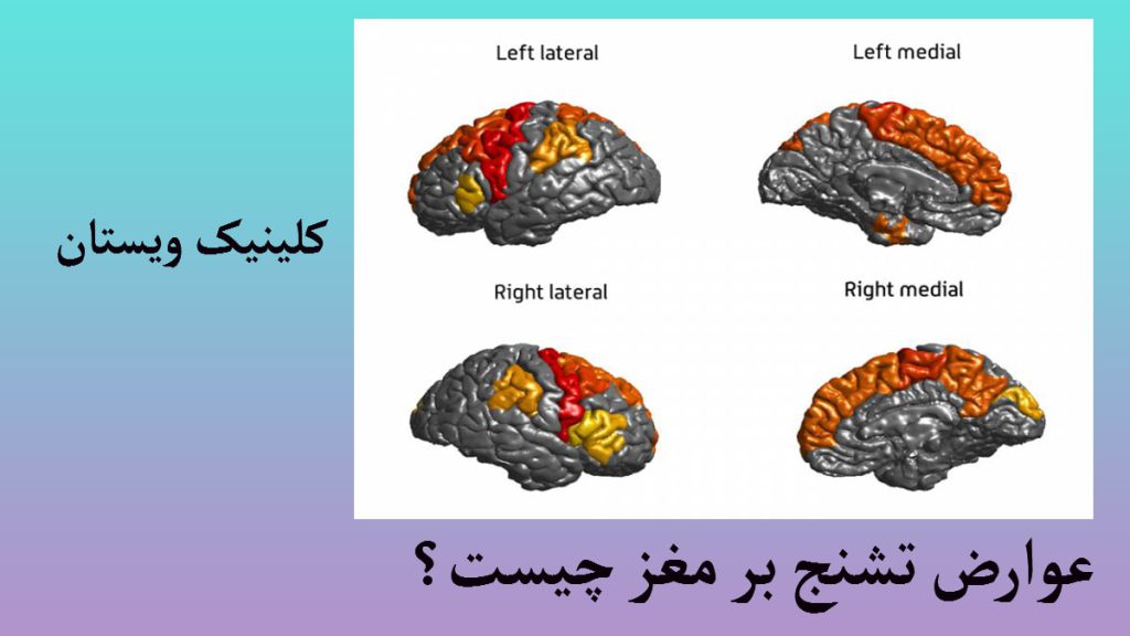 عارض تشنج چهار تصویر از مغز در یک قاب که عوارض تشنج بر مغز را نشان می دهد