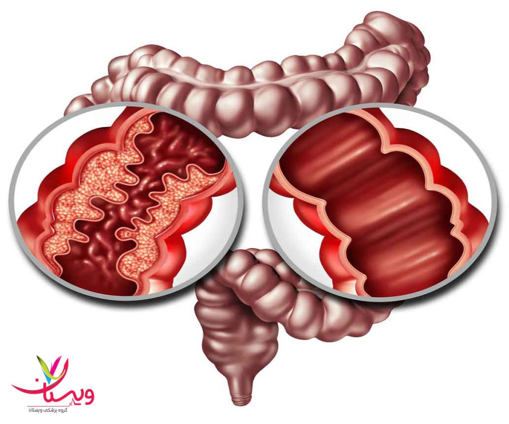بیماری کرون چیست + علت و علائم اولیه | طول عمر بیماران کرون!