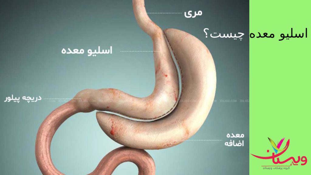 گاسترکتومی آستین اسلیو معده !! بهترین دکتر برای عمل اسلیو معده✚فیلم اسلیومعده