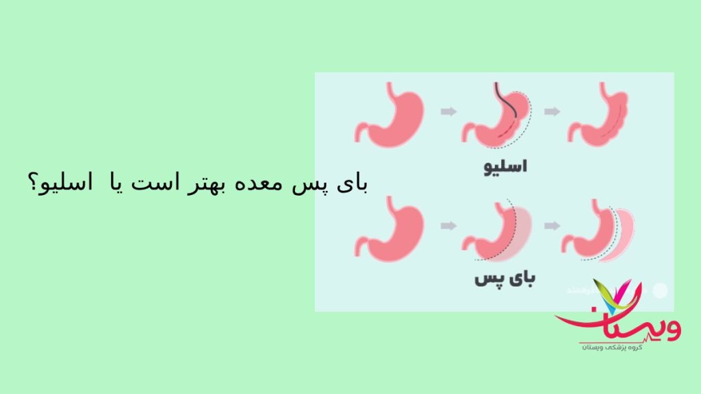 تفاوت دو روش جراحی برای لاغری تفاوت دو عمل برای کاش سایز ولاغری نشان داده شده است