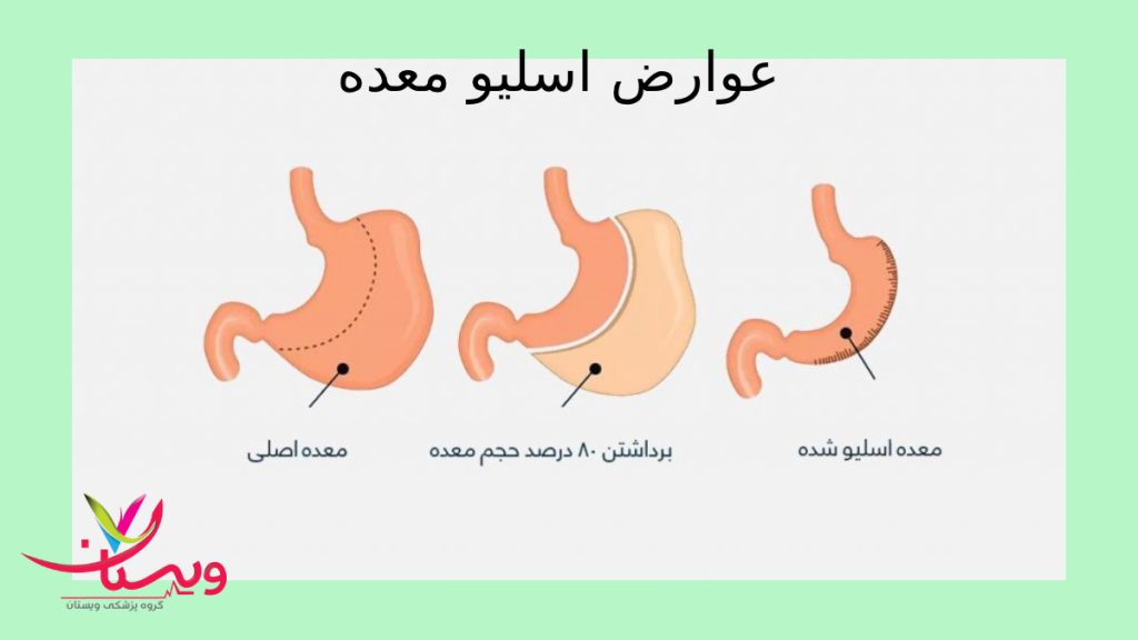جراحی همراه با عوارض مراحل عمل اسلیو معده