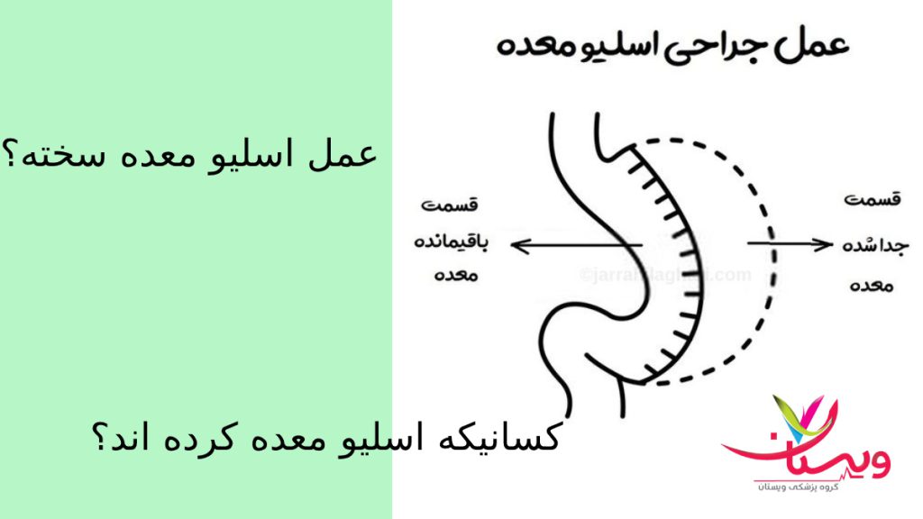 تجربیات افرادی که عمل اسلیو معده انجام داده اند معده ای جراحی اسلیو معده انجام داده اند