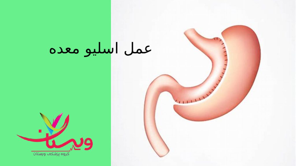 یکی از روشهای جراحی برای کاهش وزن معده ای که جراحی انجام داده برای لغری وکاهش اشتها