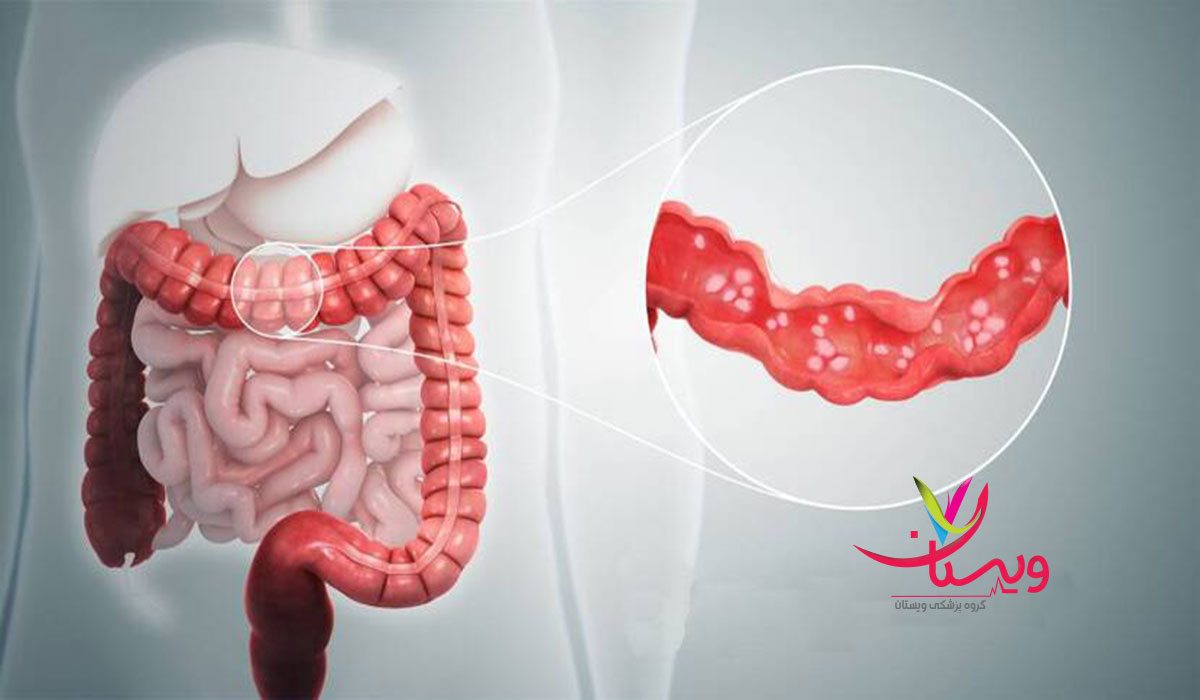 درمان جدید بیماری کرون