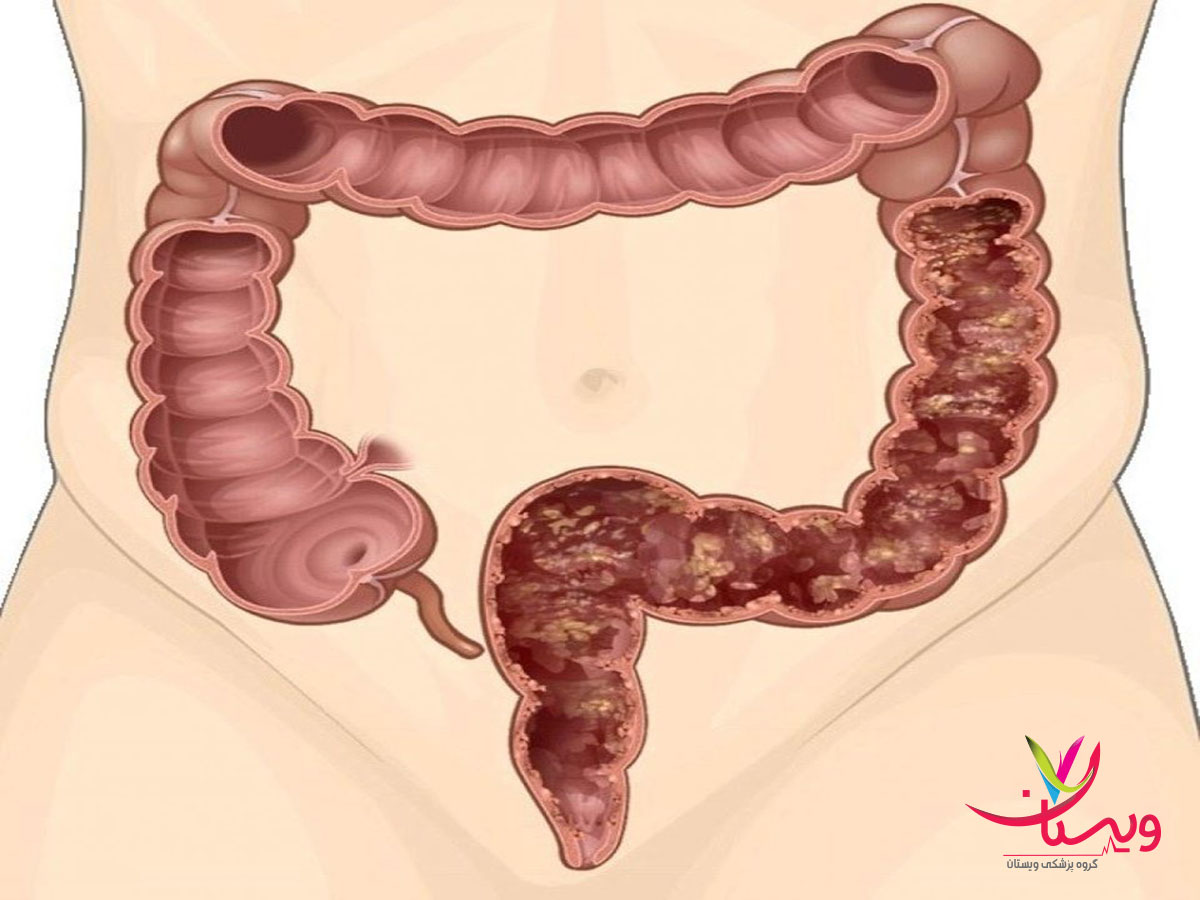عوارض ابتلا به بیماری کرون