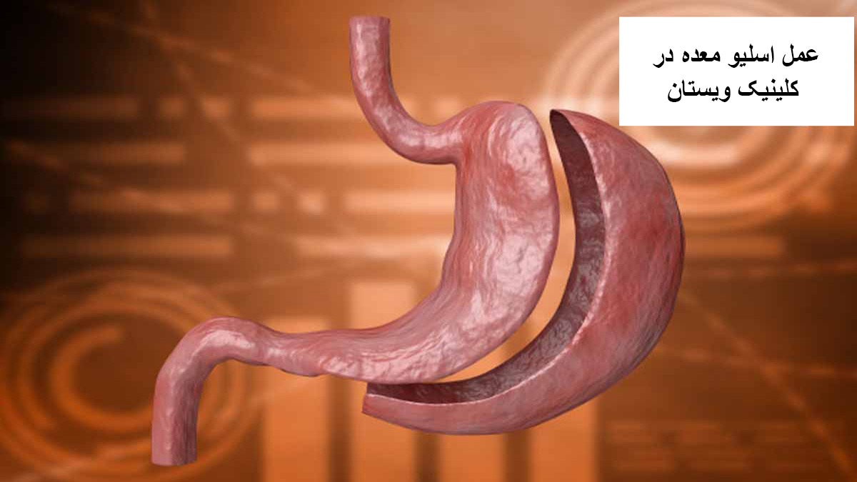 عمل اسلیو معده در کلینیک ویستان