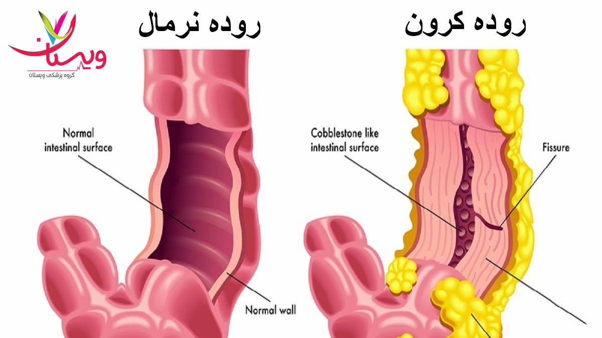 عکس روده بیمار مبتلا به کرون و روده سالم