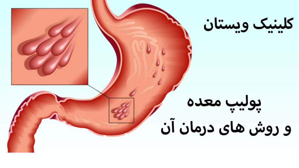 یک معده که دچار پولیپ معده شده است