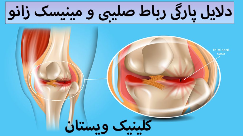 یک زانو با مشکل پارگی رباط صلیبی که قسمتی از آن بزرگتر نشان داه شده است