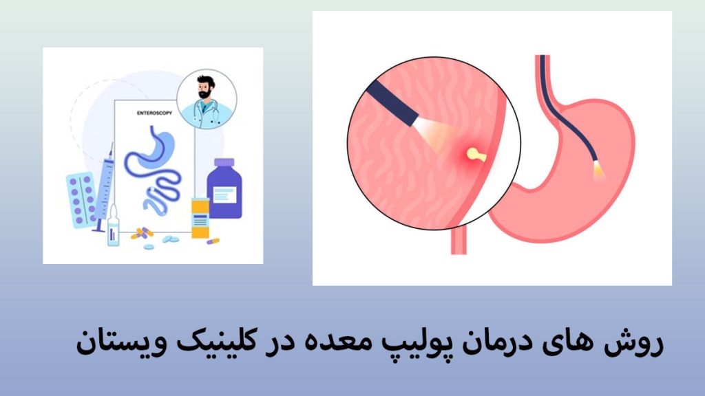 دو تصویر در یک قاب از پولیپ معده و روش های درمان آن