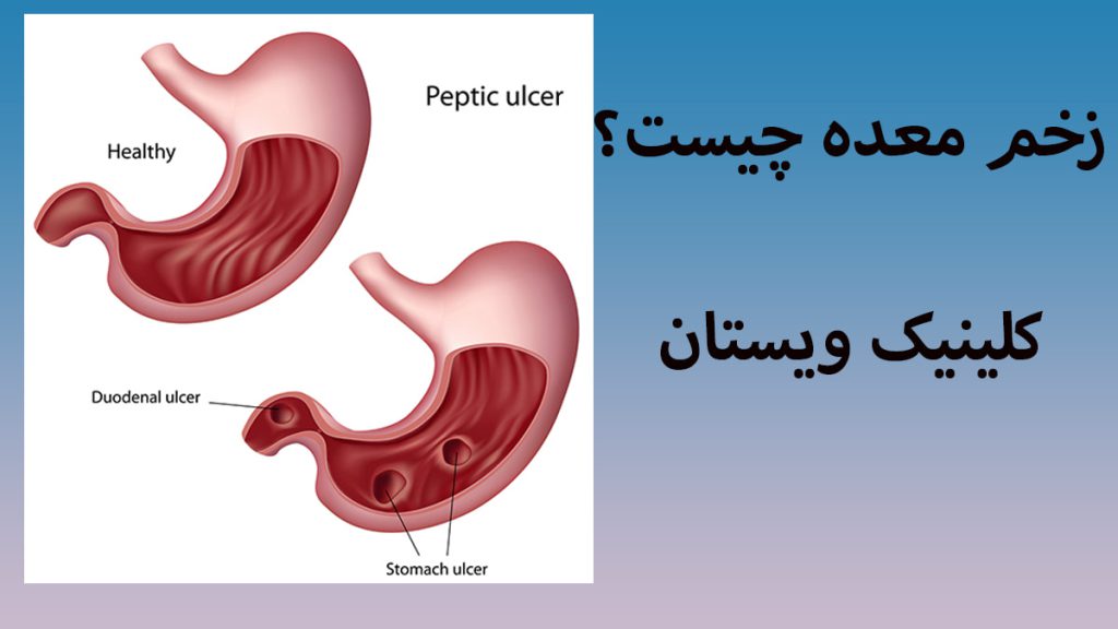 دو تصویر از معده که دچار زخم معده شده است در یک قاب