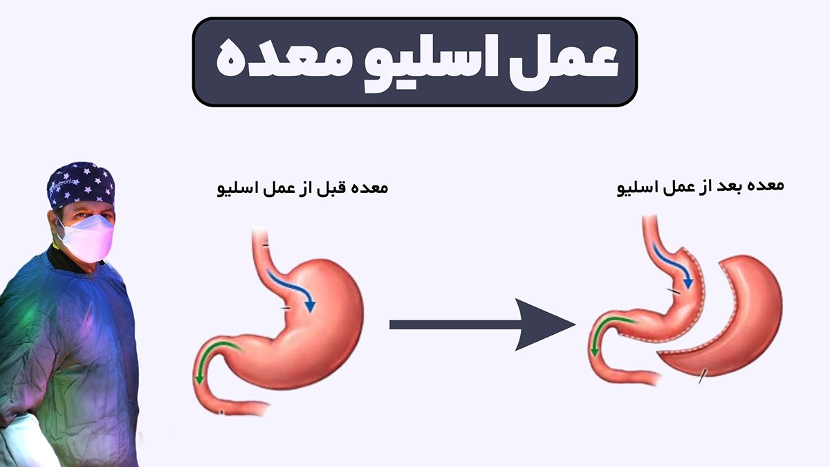 با عمل اسلیو معده لاغر می شوید