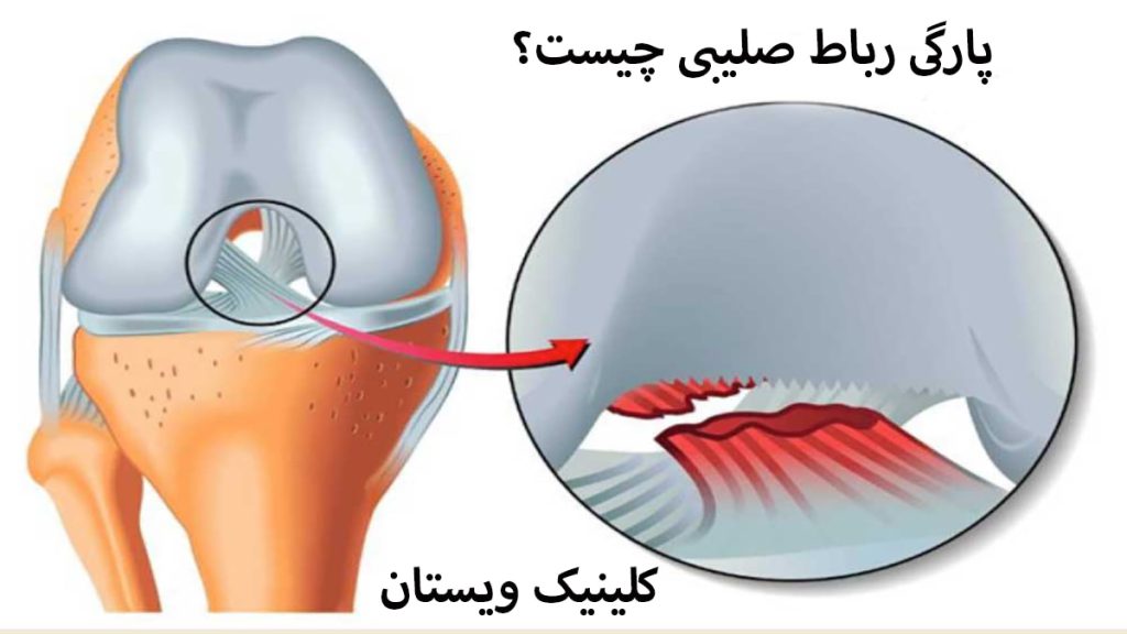 یک زانو که دچار پارگی رباط صلیبی شده است
