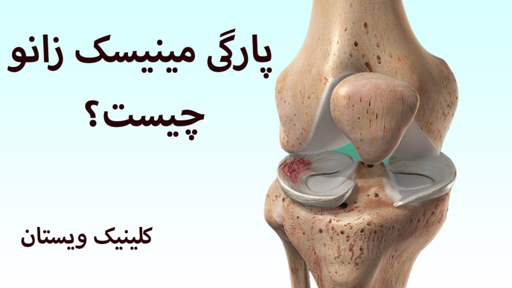 یک زانو که مینیسک آن دچار پارگی شده است
