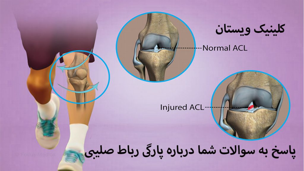 زانوی یک شخص و تصویری کوچک از پارگی رباط صلیبی آن