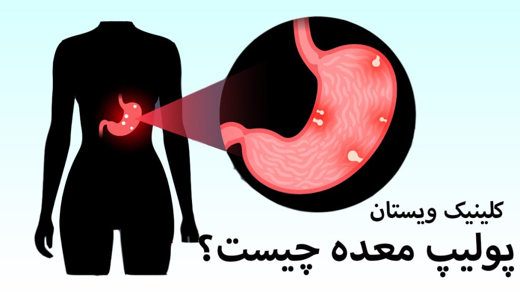 یک شخص که بدن او با رنگ مشکی نشان داده شده است و تصویری زوم شده از پولیپ معده او
