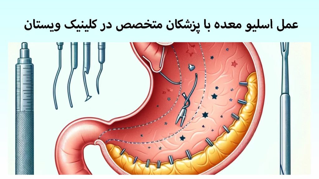 تصویری انیمیشنی از عمل اسلیو معده
