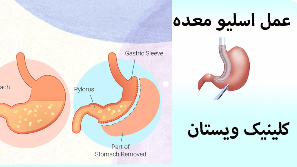 سه تصویر از معده قبل و بعد از عمل اسلیو معده