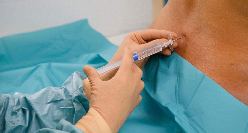 عوارض تزریق اپیدورال در کمر + مدت زمان تاثیر تزریق اپیدورال✘