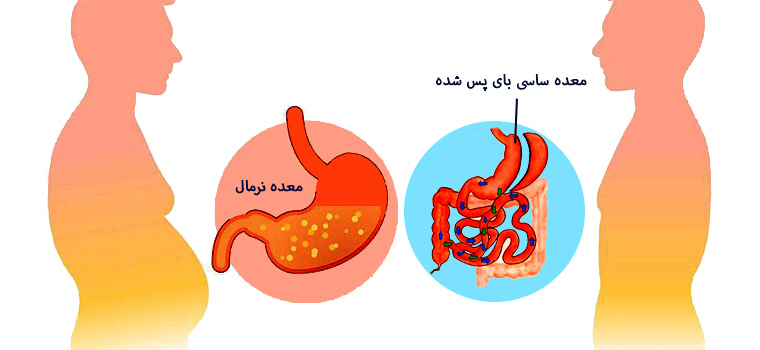 فواید آندوسکوپی قبل از اسلیو معده