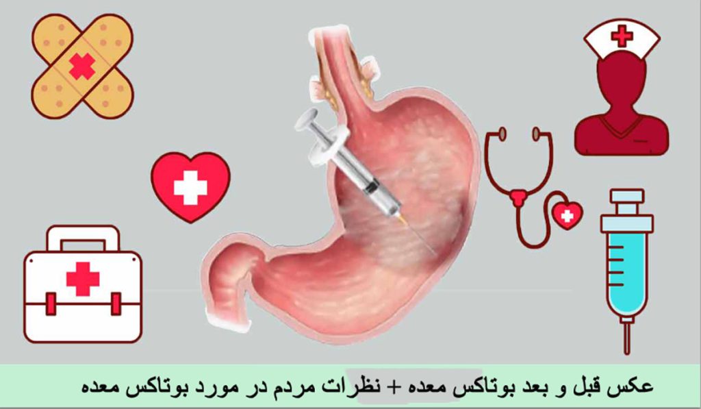 عکس قبل و بعد بوتاکس معده + نظرات مردم در مورد بوتاکس معده ✔